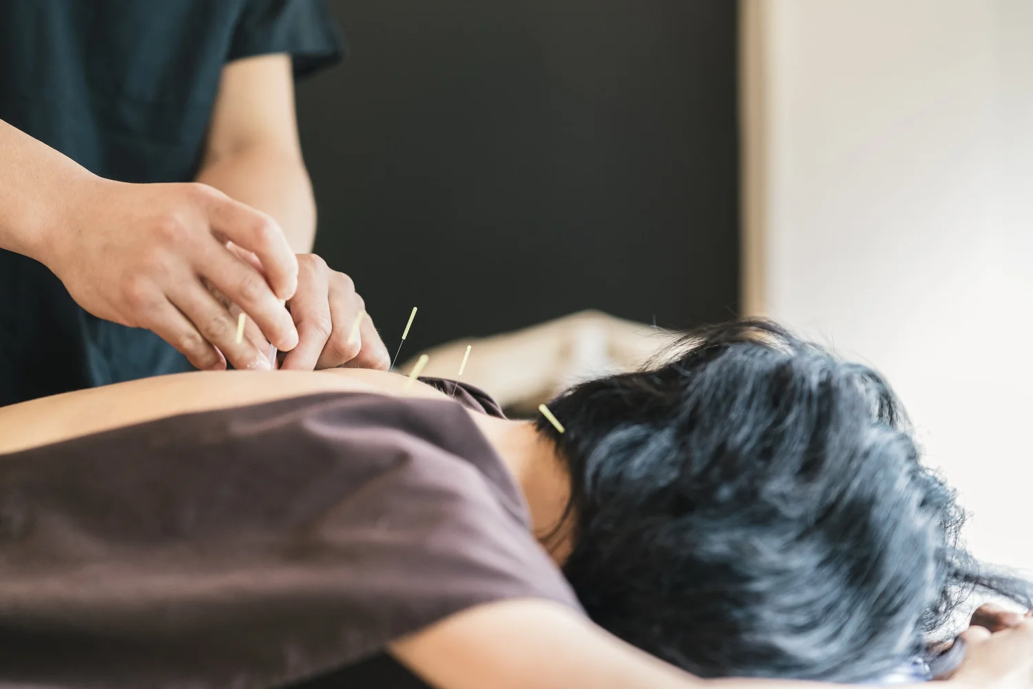 Acupuncture needles with cupping treatment on a patient's back