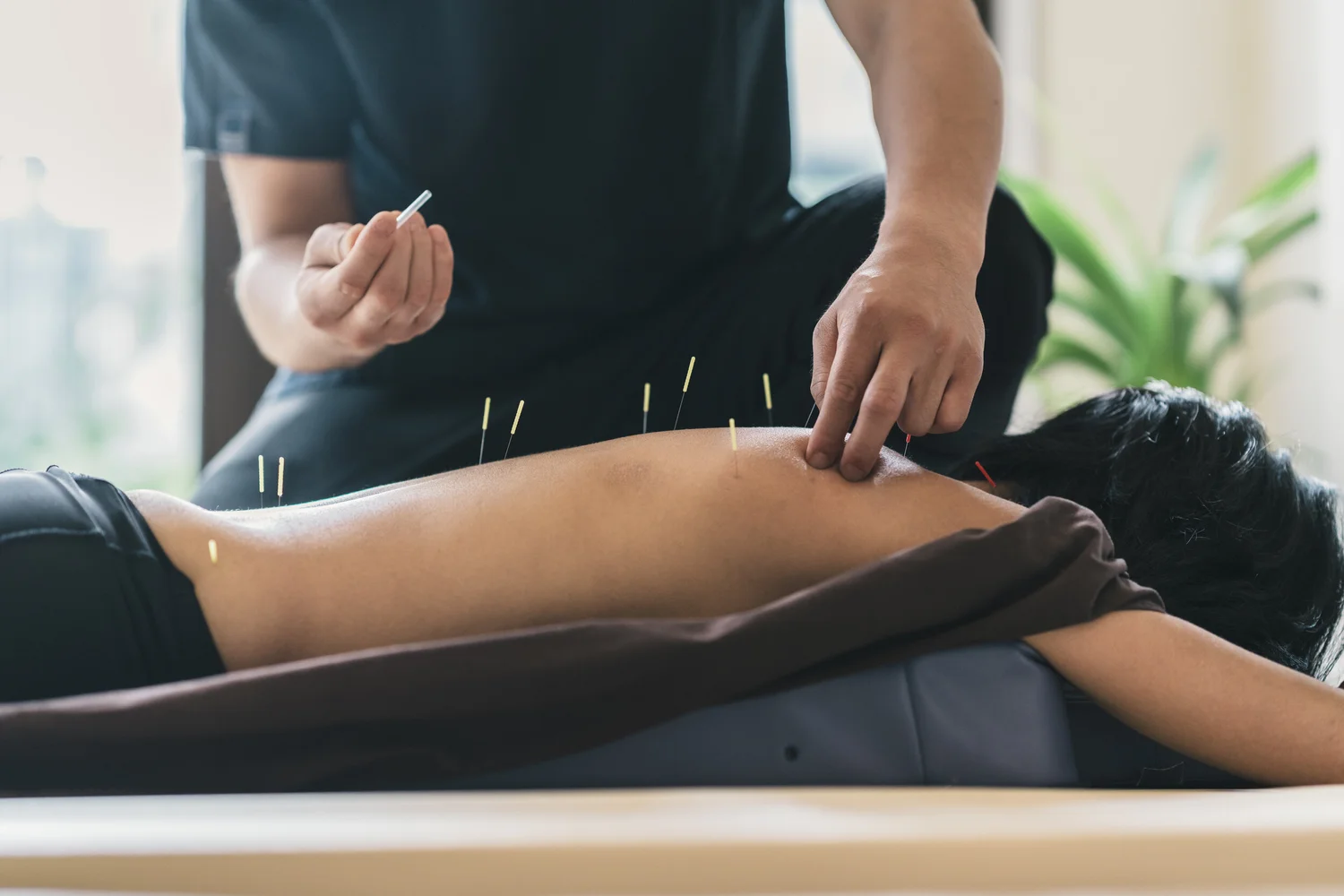 Acupuncture needles placed along a patient's shoulder