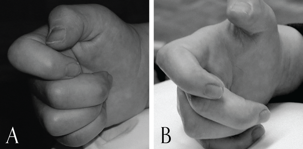 Before and after photos of a hand treated with intramuscular stimulation