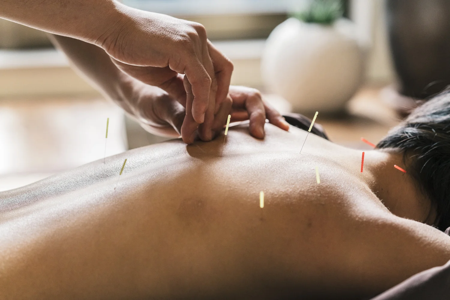 Practitioner placing acupuncture needles